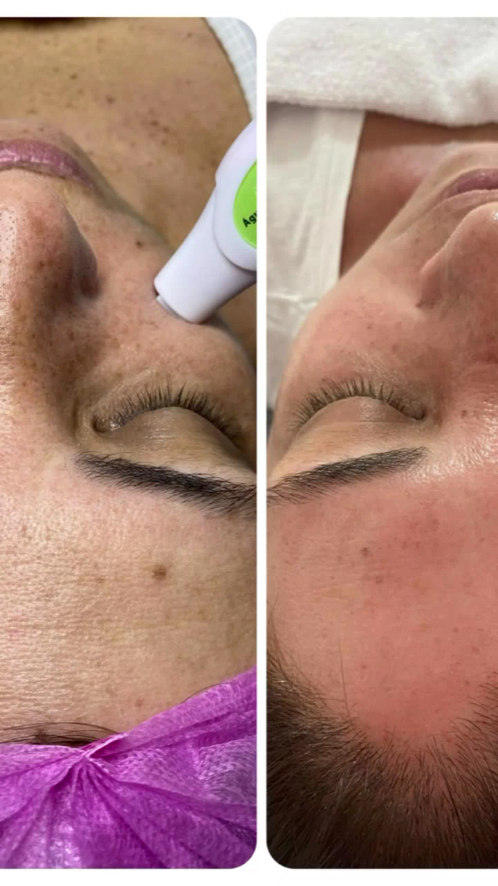 Detalhe da região dos olhos de paciente durante a avaliação de linhas de expressão para aplicação de toxina botulínica