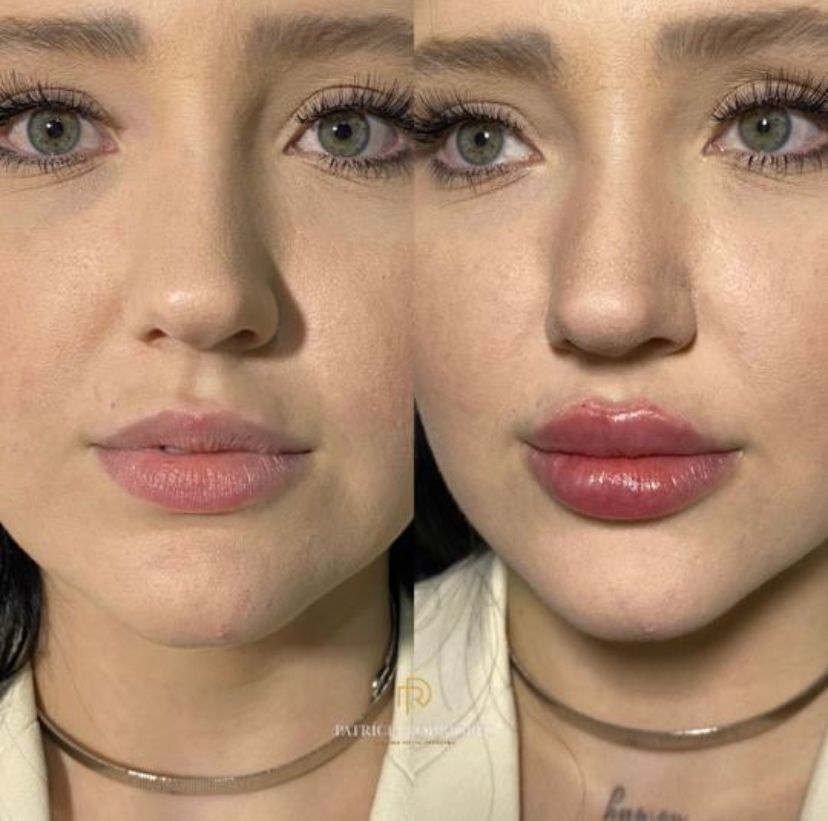 Lábios da paciente fotografados antes do preenchimento labial